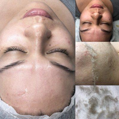 Before and after Dermaplaning and CIT (collagen induction therapy)