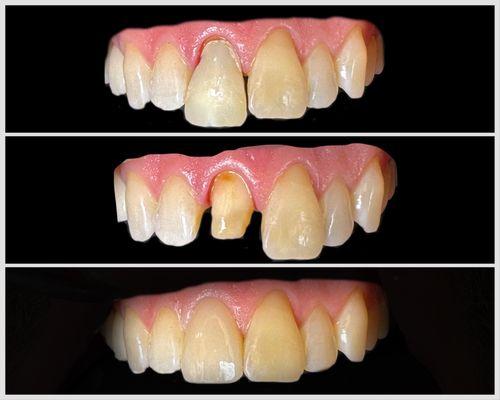 Custom shade match of single zirconia crown after root canal treatment.