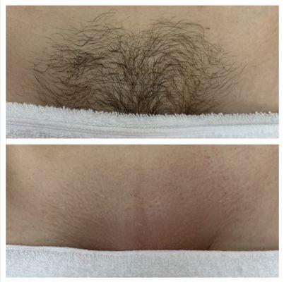 Brazilian wax before & after with flawless results!