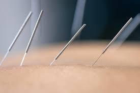 Acupuncture