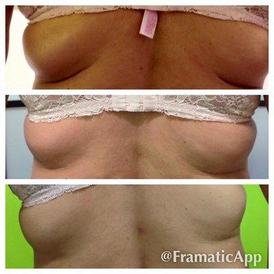 Cavitation 4 sessions and 8 sessions results. 47 years old client.