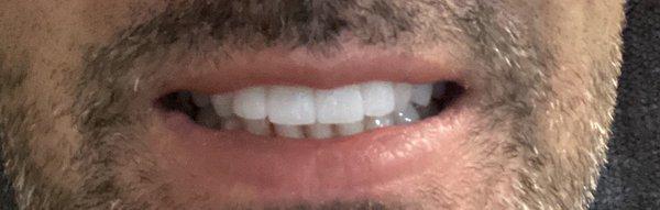 4 crowns (upper front teeth) loving the new smile!