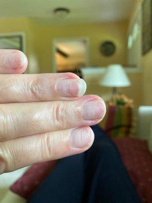 Damaged nails