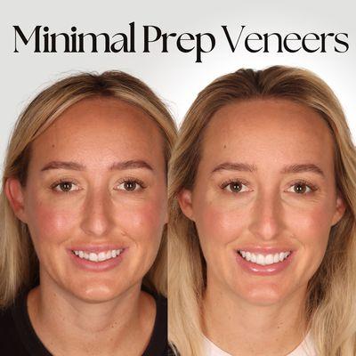 8 minimal prep veneers to balance the smile