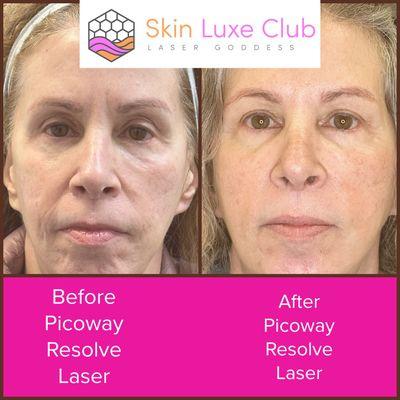 Laser Skin Rejuvenation.