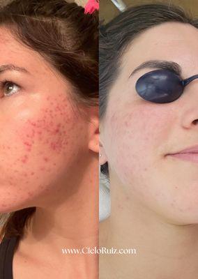 Acne Clearing Program