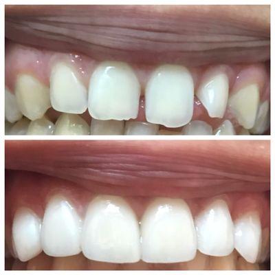 Six upper porcelain crowns/ veneers