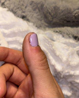 Swollen after lady used cuticle pusher aggressively