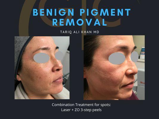 Combination treatment for hyperpigmentation - Dr Tariq Ali Khan