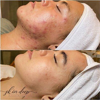 Skin Deep By Whitney at Nurtura Medspa