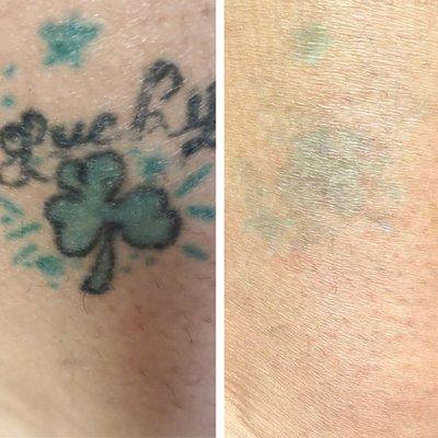 Before & After 3 session of Tattoo Removal