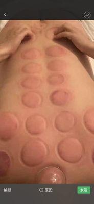 Cupping