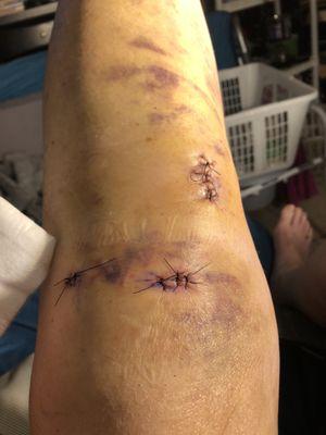 ACL reconstruction by Dr. Kenneth Berliner