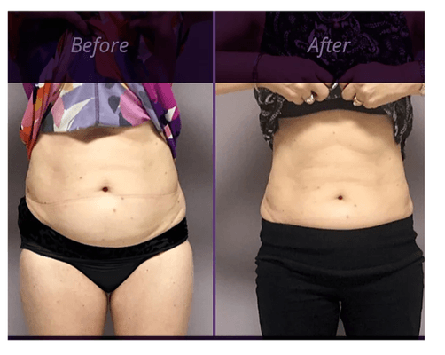 Our client shrink fat cells in 10 sessions!