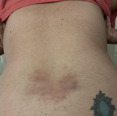 Bruised lower back from massage