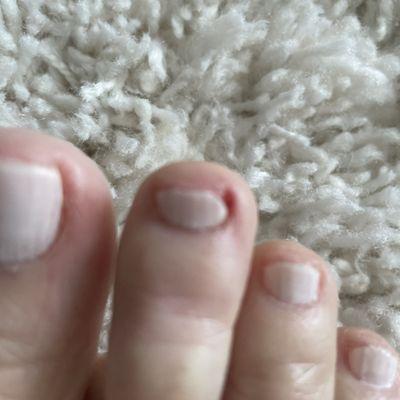 Nicked painful toe.