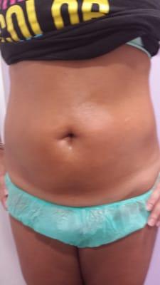 I'm trying the laser lipo and ultrasound cavitation with Claudia and I'm super excited. Noticeable changes in few sessions