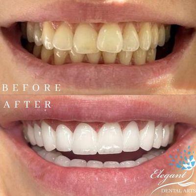 Veneers  at Elegant Dental Arts in Freehold, NJ