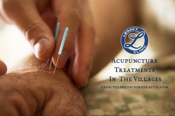 Acupuncture treatments in The Villages