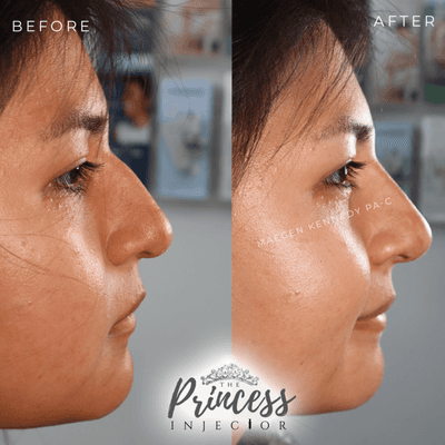 Non-Surgical Rhinoplasty by PA Maegen Kennedy - Orlando FL