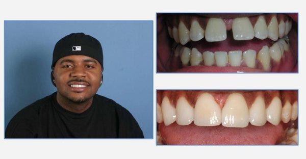 Lucas - veneers to close gaps!