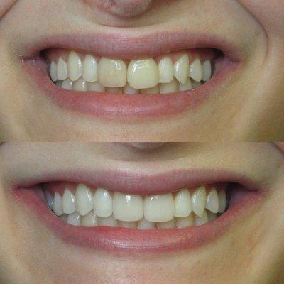 BEFORE (top) & AFTER (bottom)  Teeth Whitening & Crowns