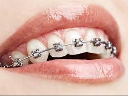 Traditional Braces