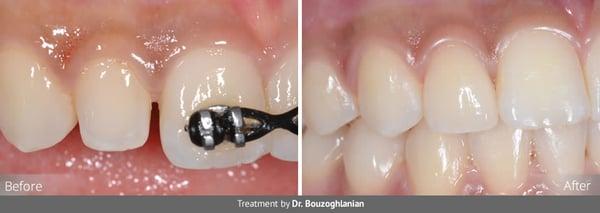 Close spaces with veneers for unmatched results!