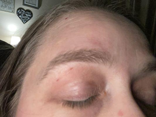 Eyebrow burn