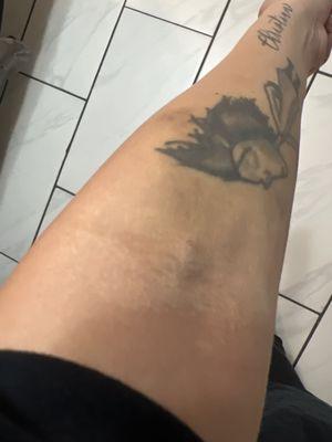 Bruising and swollen vein