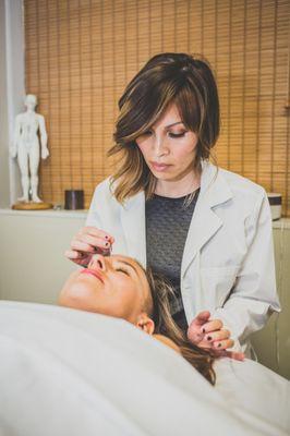 Patient receiving acupuncture to relieve her migraines.