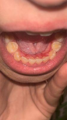 After removal of bottom expander that was embedded into child's gum line.