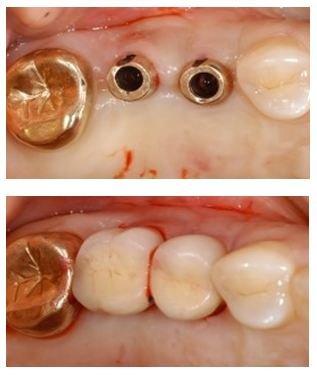 Implant Testimonial_2 (Age.53 /Male) 
 Treatment History: 6/2/2017 ~2/13/2018 Fixture- Straumann / PRP / Customized abutment / PFM Crown