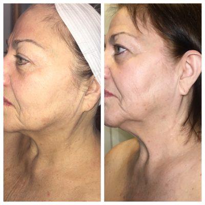 Skin tightening results after 1 session of radio frequency skin tightening