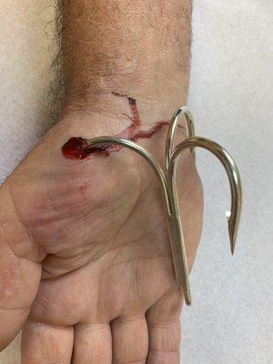 Dr. Dhaliwal removes Fish Hook under L/A in his office