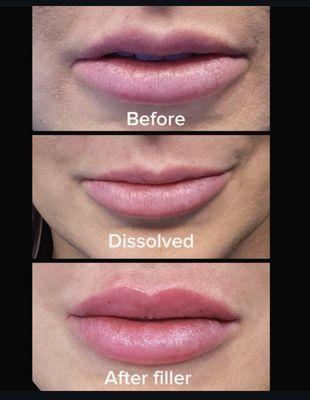 Achieved this after a couple sessions of dissolver to the top lip. As well as micro dosing dissolver to sculpt the bottom lip.