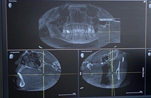 Three of the many images that where taken of my mouth today.