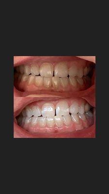 Teeth whitening - my before & after photo in just 1 session. Our winter promotion : save 25% now- 2/28/2020