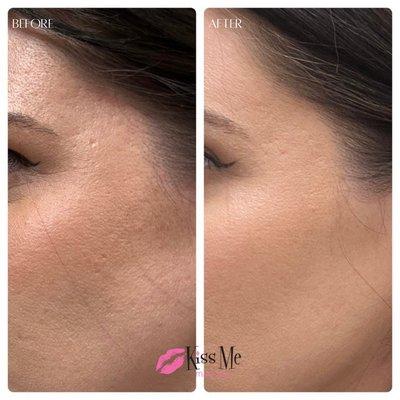 Texture/acne scar improvement with Microneedling