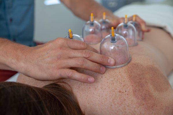 Come get cupping for a quick easy way to help your body heal itself