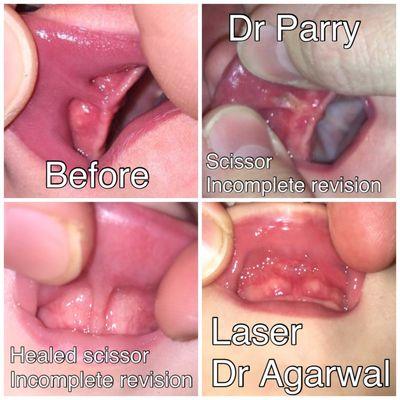 I will never recommend Dr Parry for a lip or tongue tie revision. I've meet many parents online who have had similar experiences.