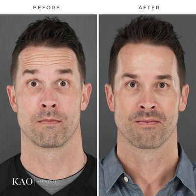 Before and after male neurotoxins - shocked face