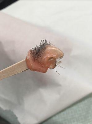 Result of hair removal from the inside of the nostrils.