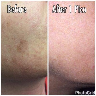 Brown spot treatment is the best!!