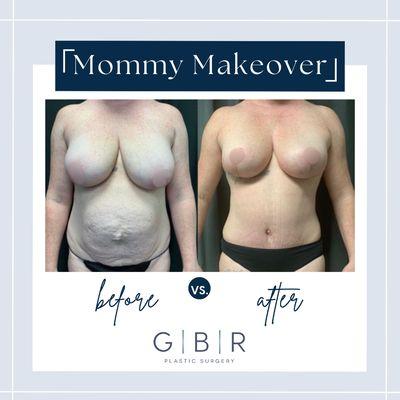 Mommy Makeover in Virginia Beach