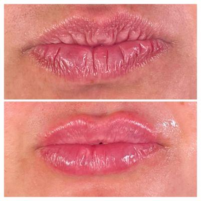 Lip Filler Before + After