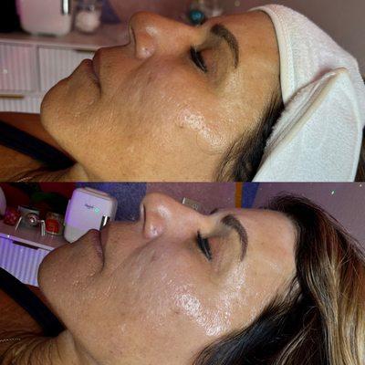 Before & After chemical peel series