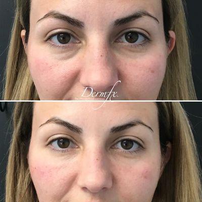 Belotero undereye filler