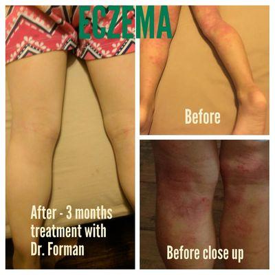 Eczema treatment with Dr. Forman