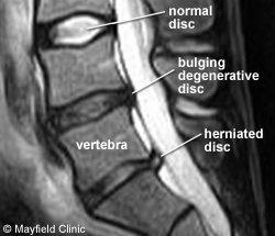 Non-surgical treatment for spinal disc injuries